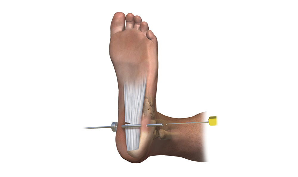 Endoscopic plantar fasciotomy procedure using a minimally invasive camera to treat chronic plantar fasciitis and heel pain