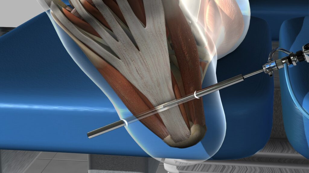 Endoscopic plantar fasciotomy procedure using a minimally invasive camera to treat chronic plantar fasciitis and heel pain